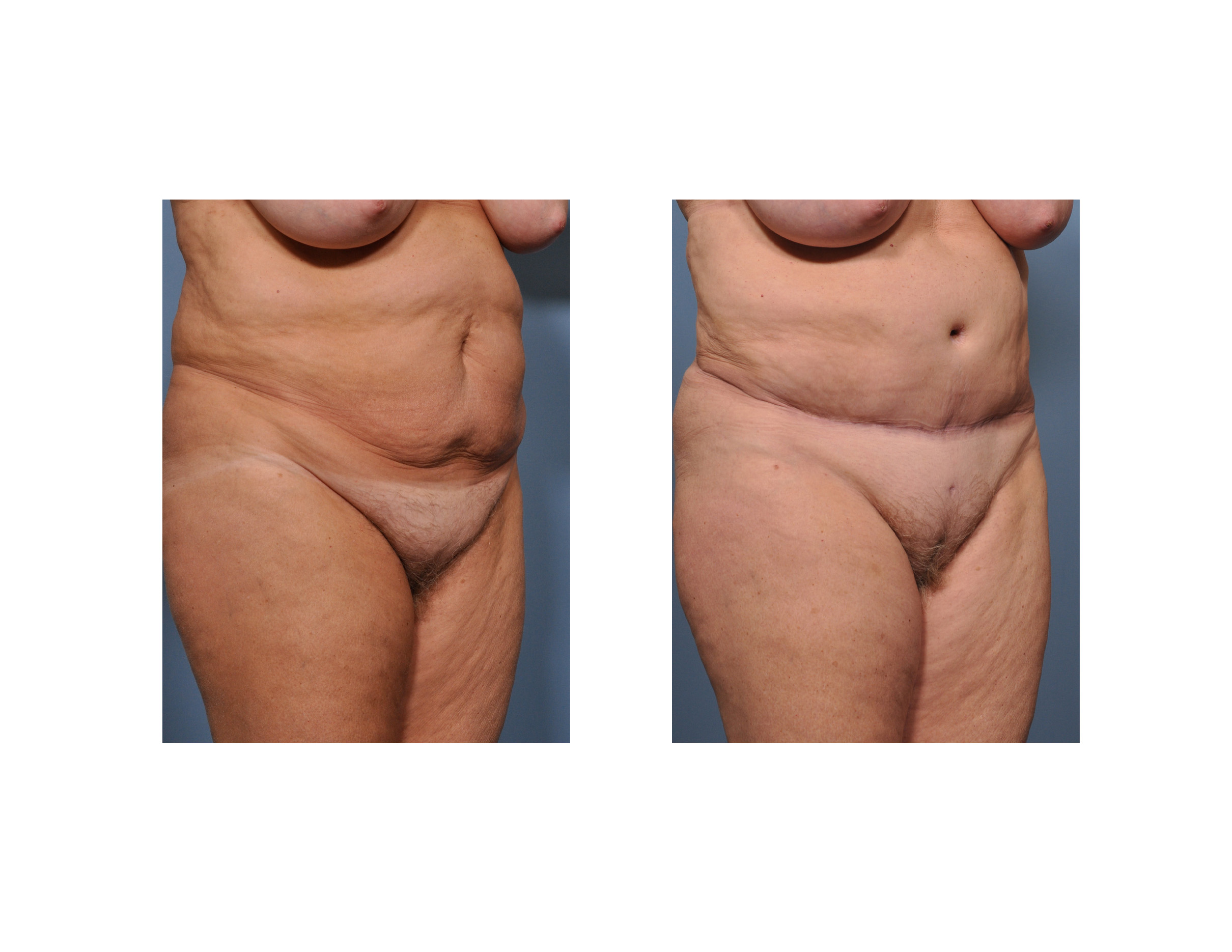 How long does the swelling last after a tummy tuck? - Quora