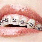 Braces and Cheek Implants Dr Barry Eppley Indianapolis