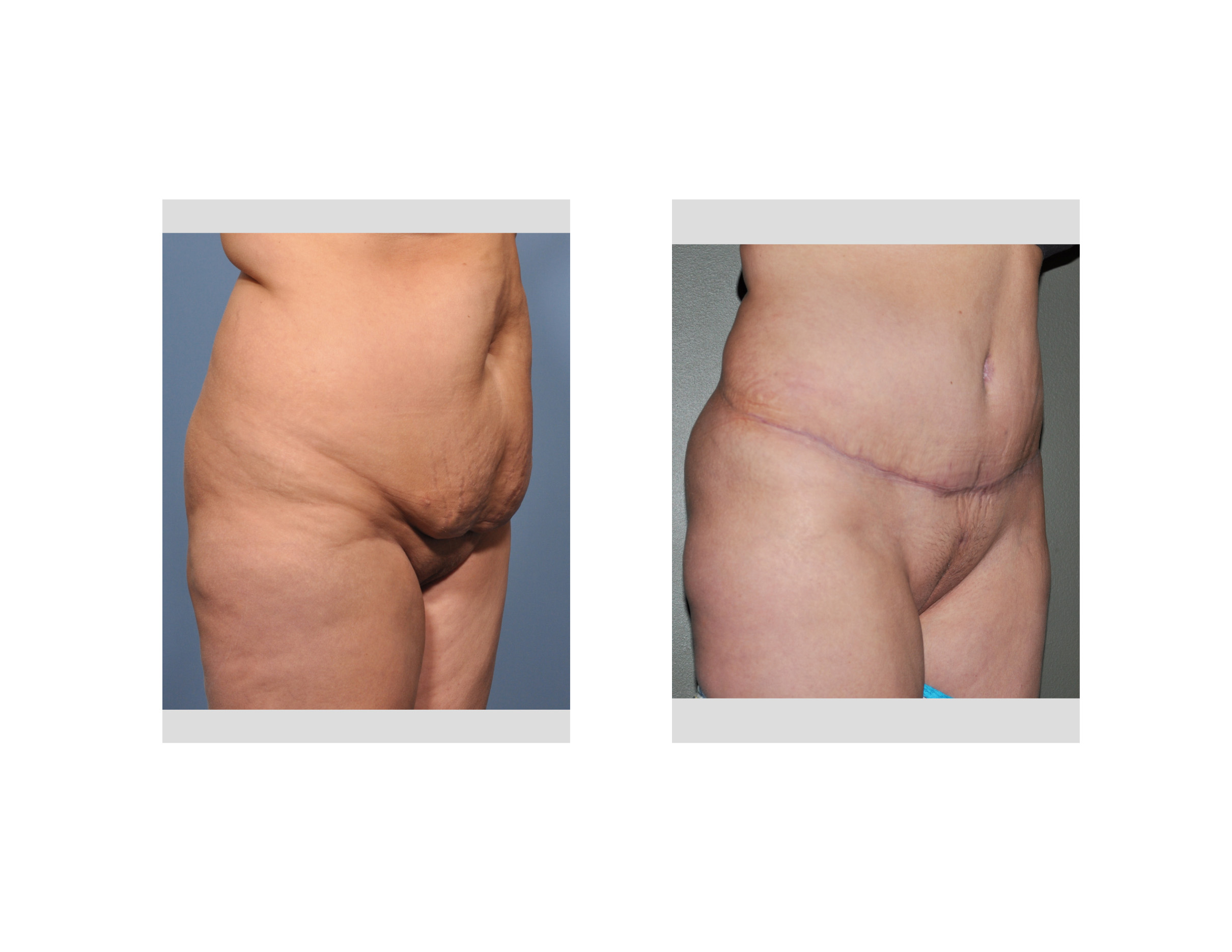 What Is The Cost Of A Tummy Tuck? - Plastic Surgeon