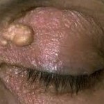 Eyelid Xanthelasma Removal Dr Barry Eppley Indianapolis