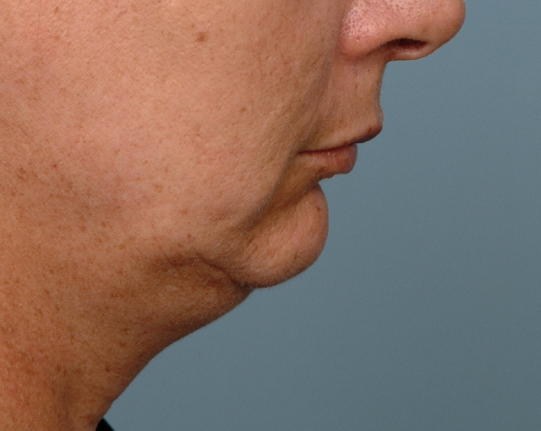 Facial Implants Plastic Surgeon Dr Barry L Eppley Md