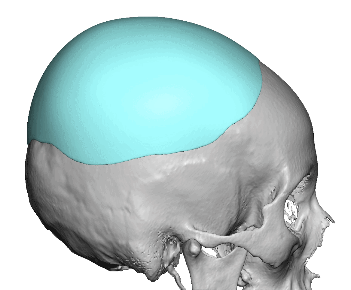 Skull Reshaping Plastic Surgeon Dr Barry L Eppley Md