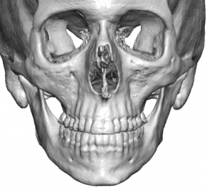 Jaw Augmentation Surgery - Jawline Enhancement Surgeon