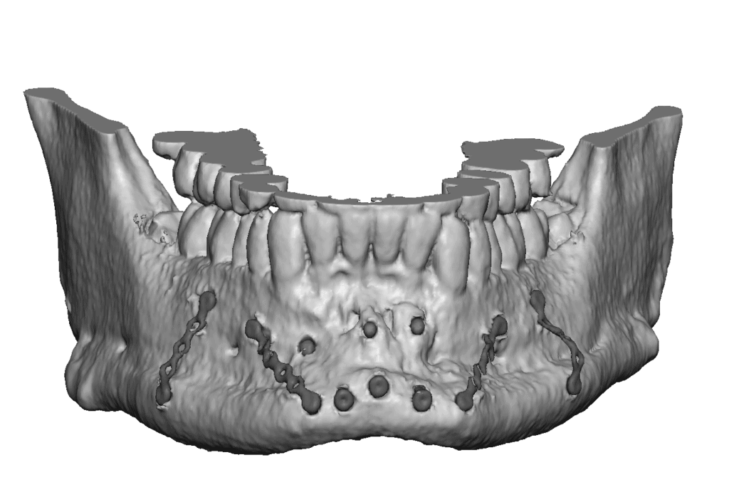 Jaw Augmentation Surgery - Jawline Enhancement Surgeon | Dr. Eppley