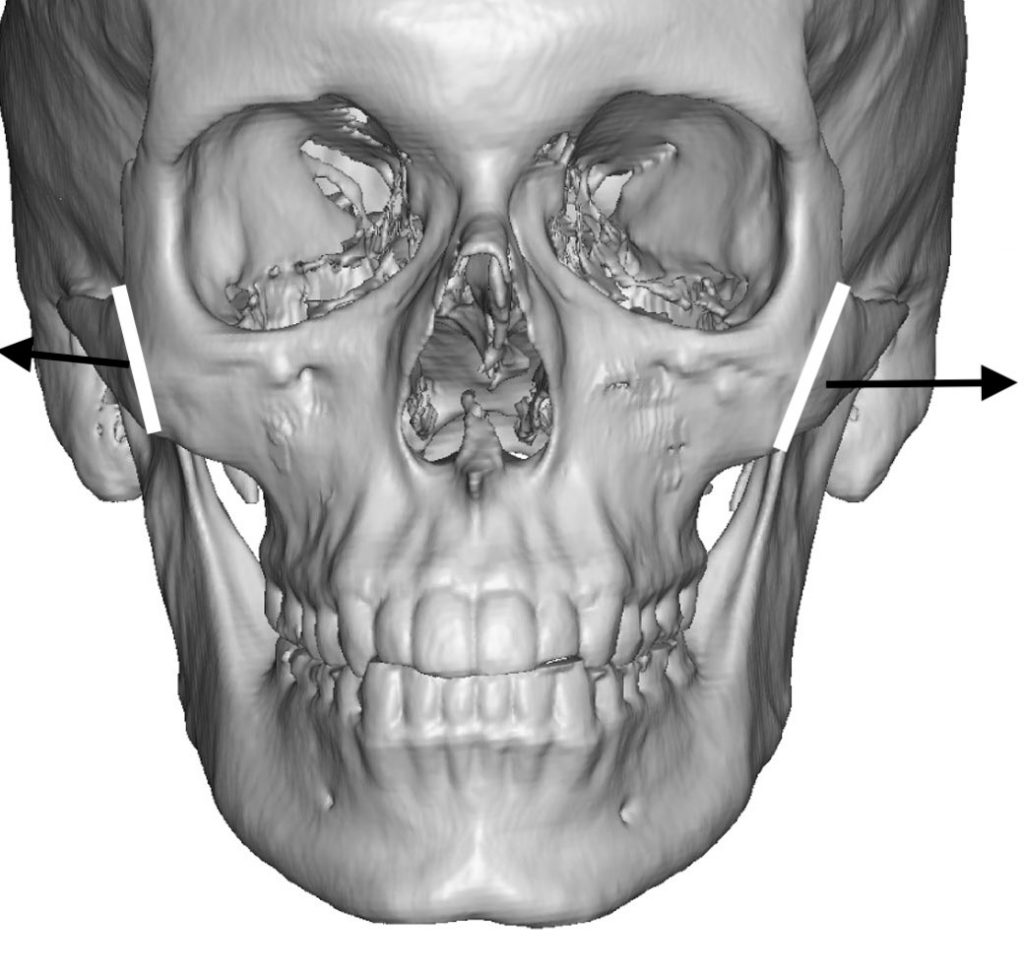 Cheek Reshaping Surgery Carmel IN - Eppley Plastic Surgery