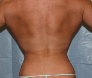 How Is Rib cage Narrowing Done? - Plastic Surgeon