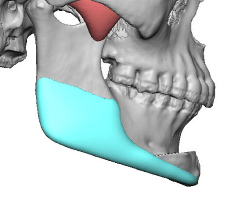 Can You Combine A Sliding Genioplasty With A Custom Jawline Implant ...