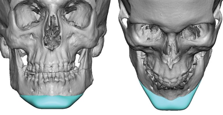 How Can I Get My Chin More Projected, Wider and Vertically Longer ...