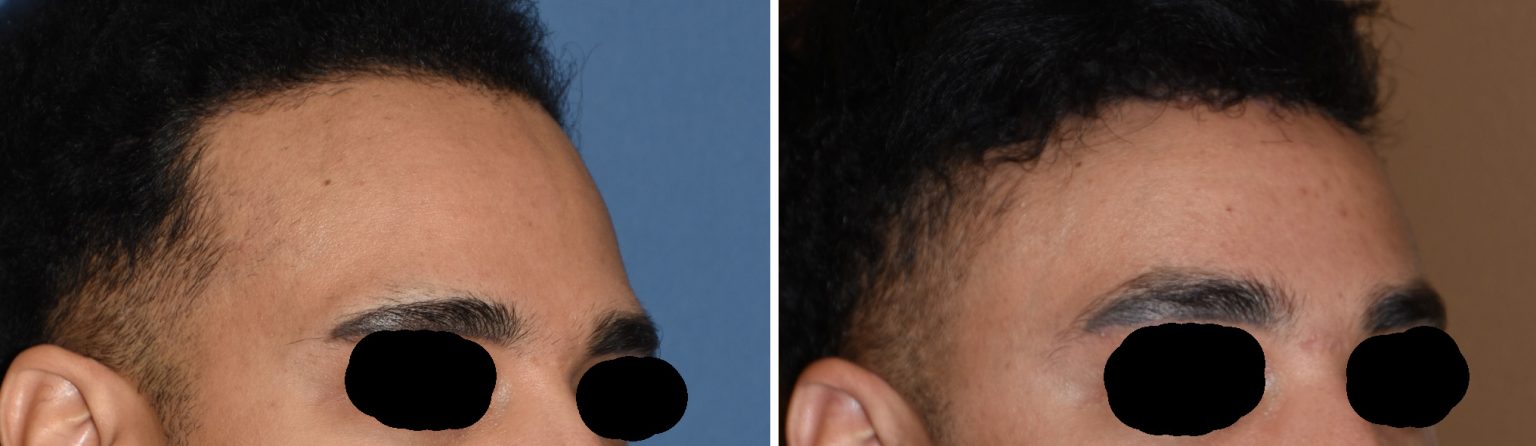 Hairline Advancement Temporal Implants Brow Bone Reduction Browlift Results Oblique View Dr Barry Eppley Indianapolis 1536x446 