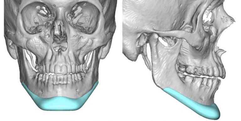 wraparound jaw implant